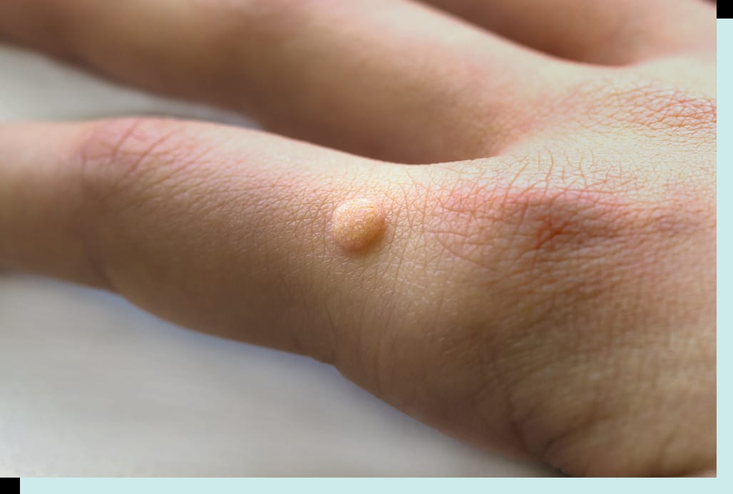 Safe and effective procedures for wart-free skin.