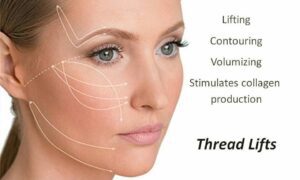 Thread lift procedure showing lifted skin after treatment.