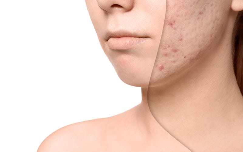 Transform Your Skin with Expert Care: Acne Treatment by Our Skincare Specialists.