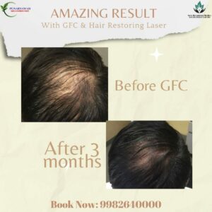 Reviving Hair After GFC: See the Transformative Effects of Laser Treatment for Restoring Healthy and Vibrant Hair!