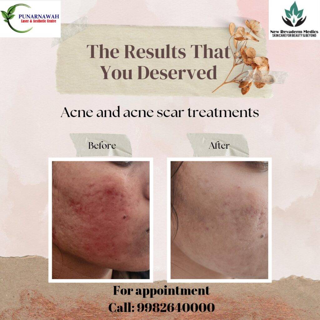 Unveiling Flawless Skin: Expert Dermatologist's Acne Scar Treatment Before and After at Punarnawah Clinic, Jaipur.