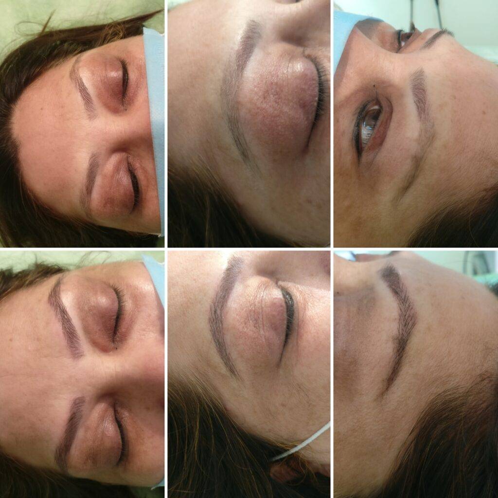 Enhance Your Look with Eyebrow Treatment at Punarnawah Clinic, Jaipur.